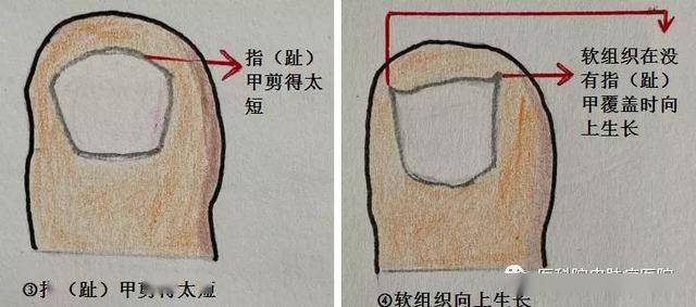 指趾甲疼痛难忍小心甲沟炎