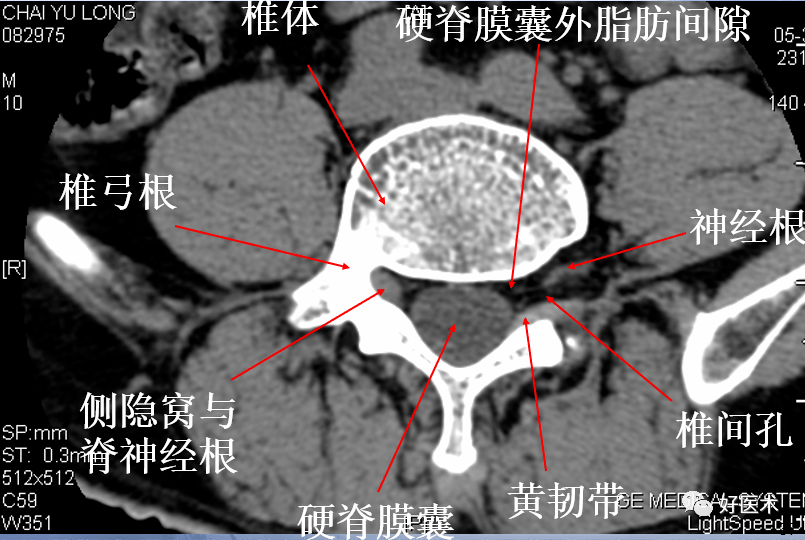 精索位置示意图CT图片