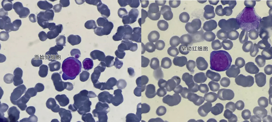 原始红细胞特点图片