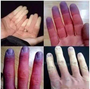 【雷诺现象】冬天来了 您的双手还好吗?_发病