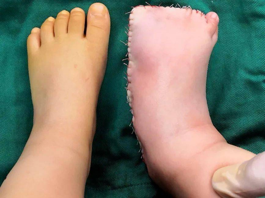 术前术后即刻大体照术前术后即刻x片病例展示二:9岁男孩,先天性双足巨