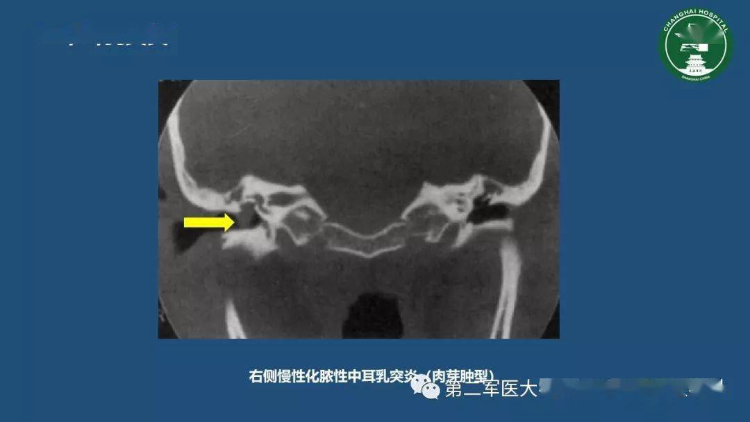 顳骨ct解剖及其常見病變