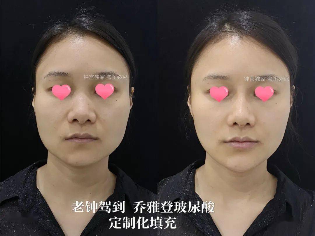 最后则是填充了西瓜的美满夫妻宫,也就是太阳穴;夫妻宫在面相学中主管