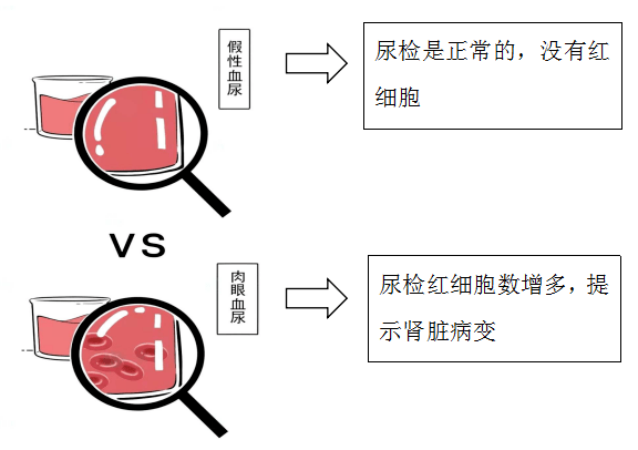 出现血尿真假难辨,一定要去医院查尿常规,一查便知真相.