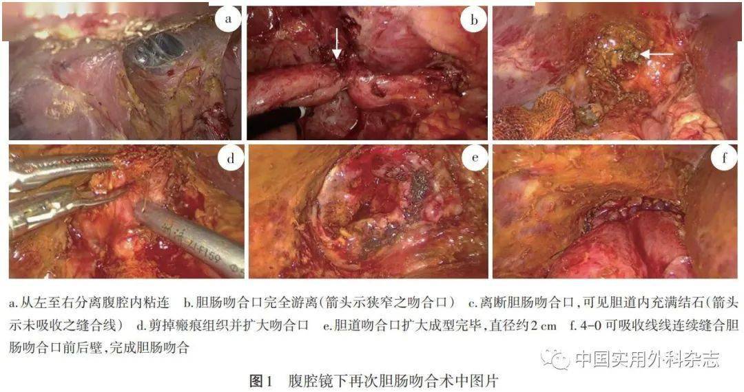 論著腹腔鏡下再次膽腸吻合治療良性膽腸吻合口狹窄探討本文配發視頻