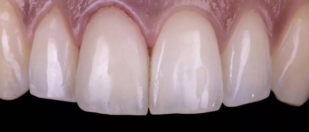 病例分享中切牙的修复复合树脂直接修复vs全瓷贴面修复