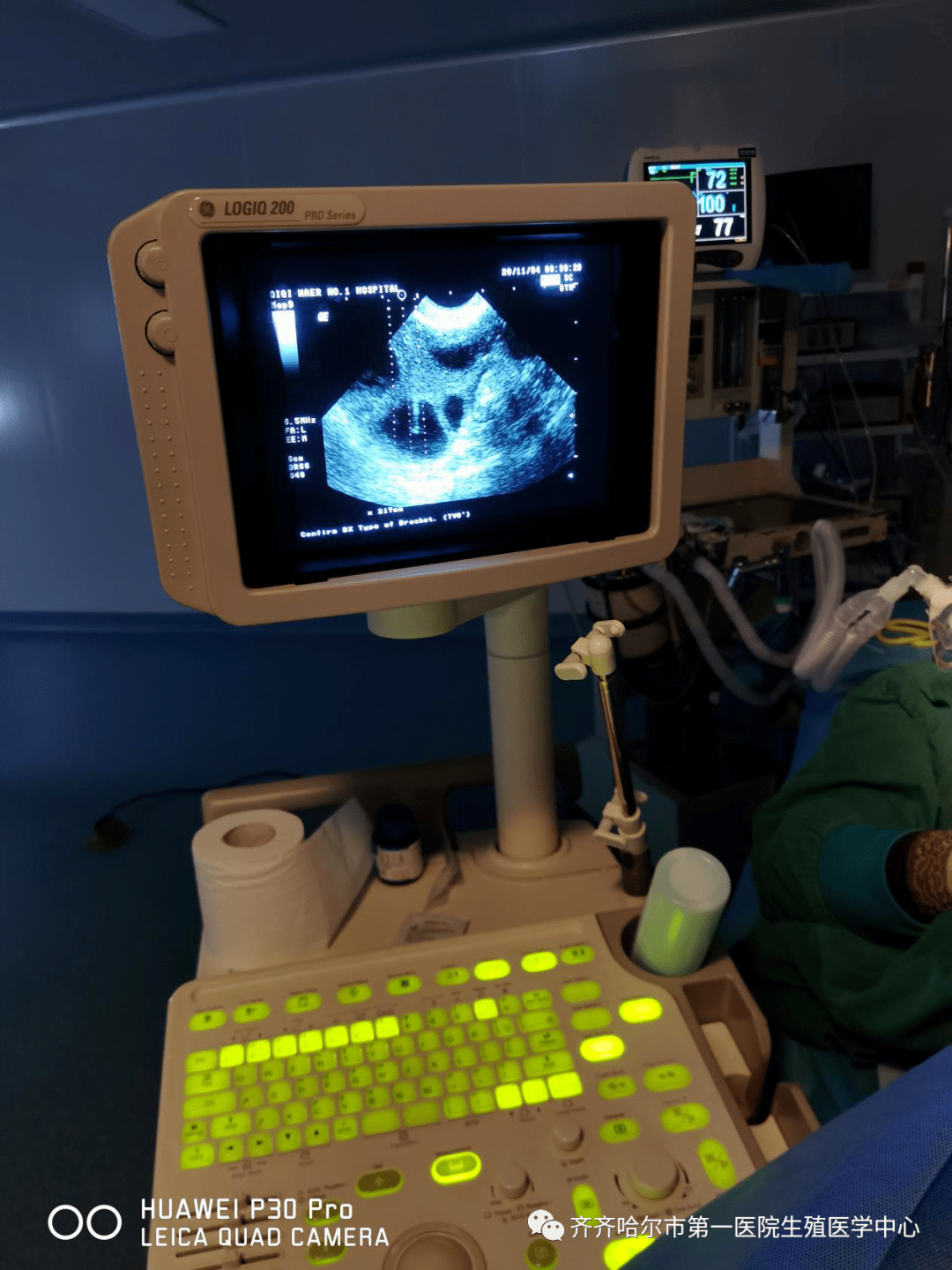 取卵术很神秘吗先美美的睡一觉