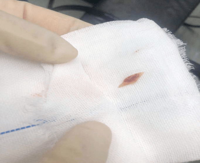 好惊险!9岁男童吃鸡肉时被鸡骨头卡住