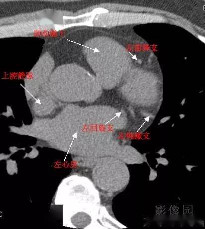 心脏ct断层解剖图中文图片