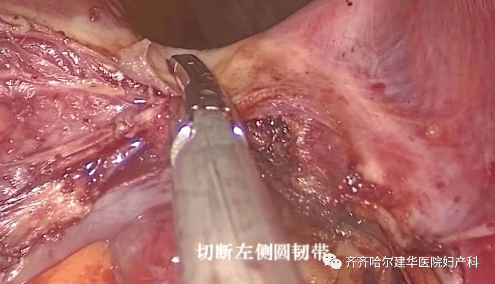 腹腔镜切除输卵管图片