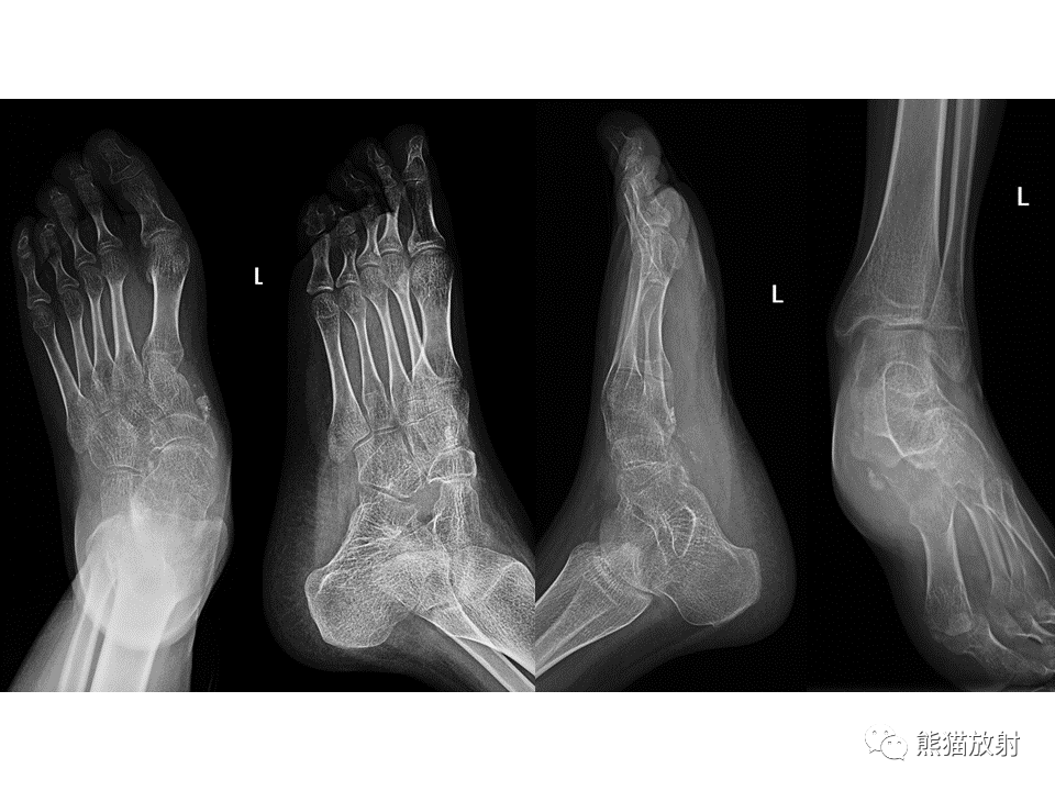 足底 滑膜肉瘤【专题】滑膜肉瘤-影像表现与病理相关性返回搜狐,查看