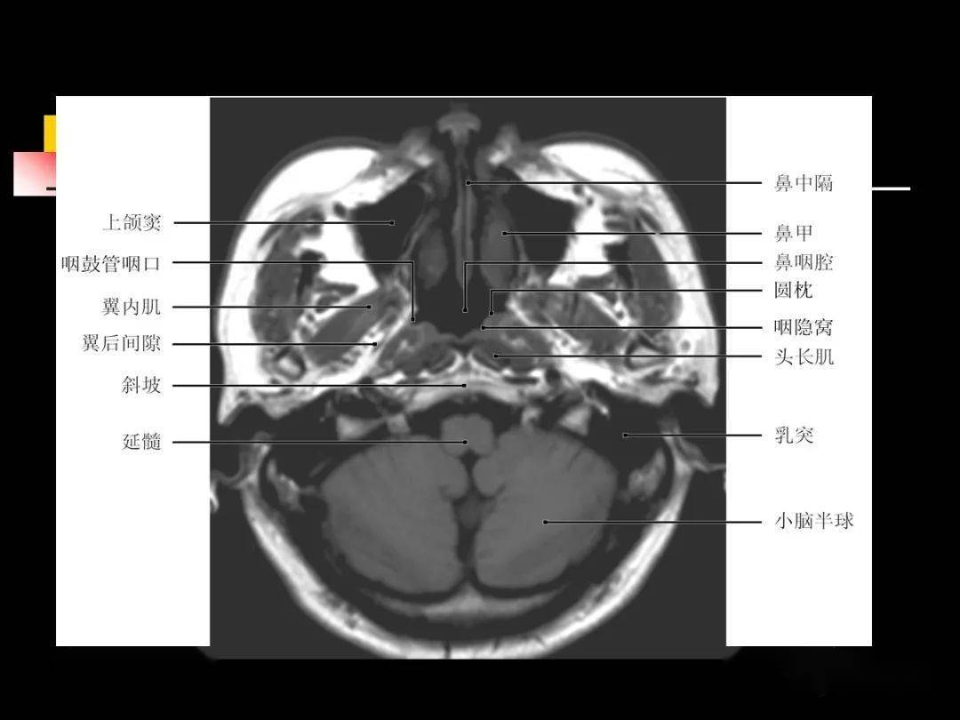 鼻部ct解剖结构图图片
