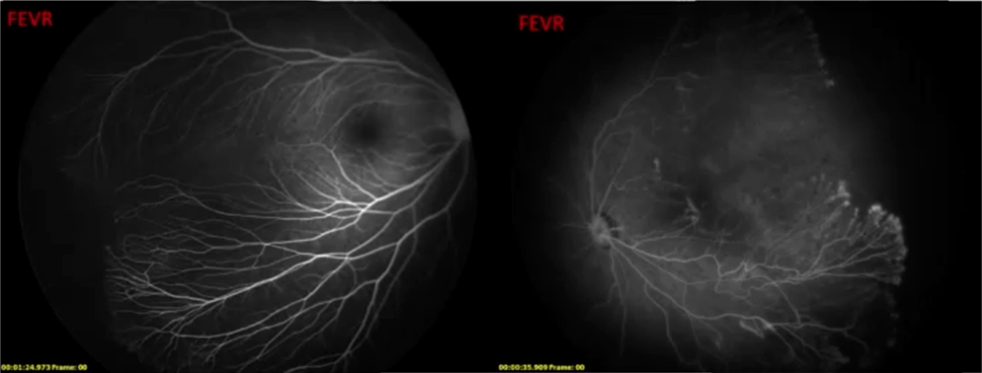 惟視診室足月無吸氧史男嬰出現眼底異常血管伴周邊部