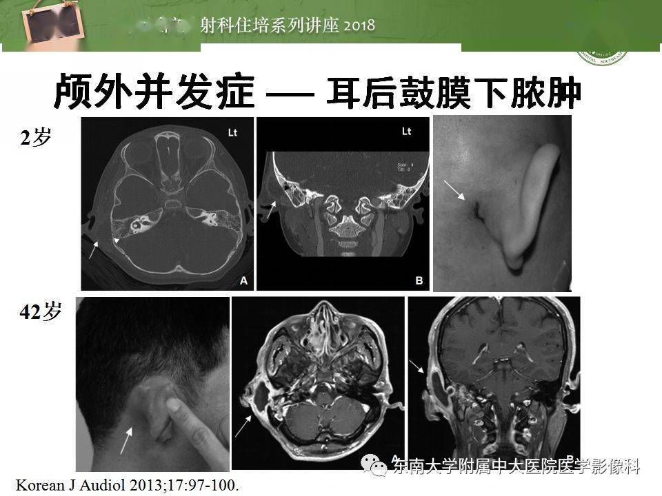 中耳解剖及中耳病变影像诊断