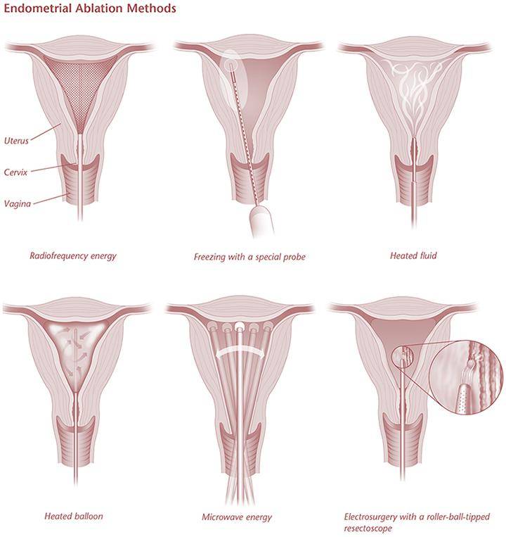 据报道,非电切镜去除术的子宫积血发生率为0.
