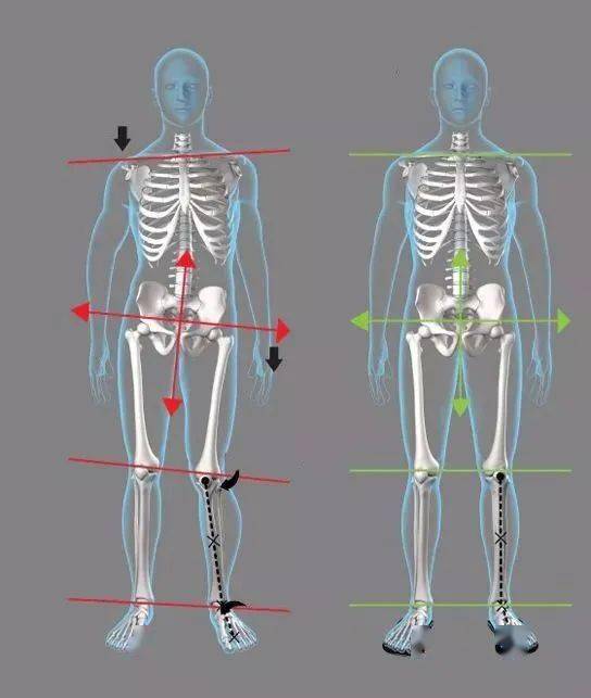 瑜伽爱好者如何快速评估自己的骨盆前倾后倾前移侧移