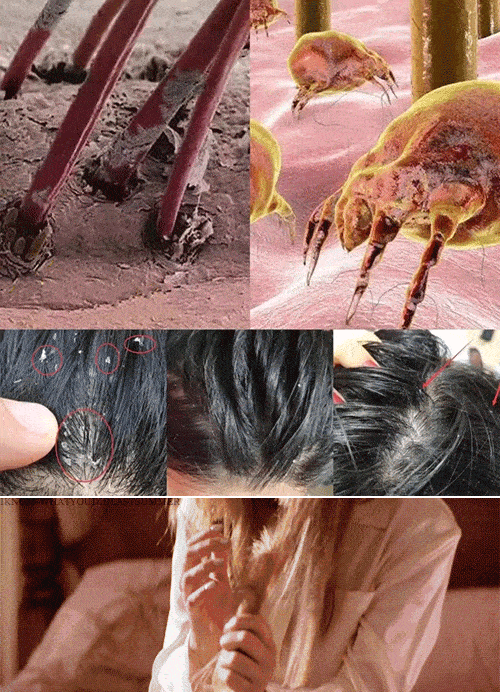 它分泌的解脂酵素,会侵蚀皮脂腺,导致头皮受损,从而引发头屑头痒,油腻