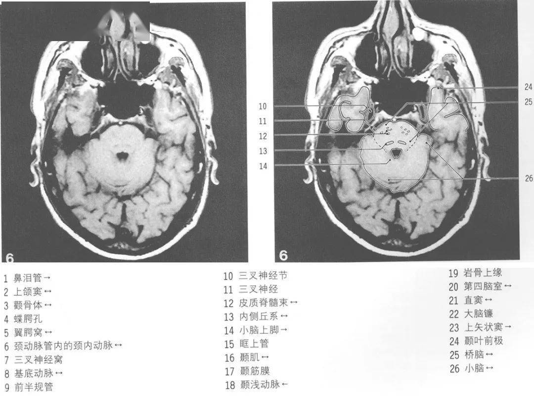 mri颅脑横断面解剖图谱