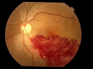 飞蚊症不管行不行?