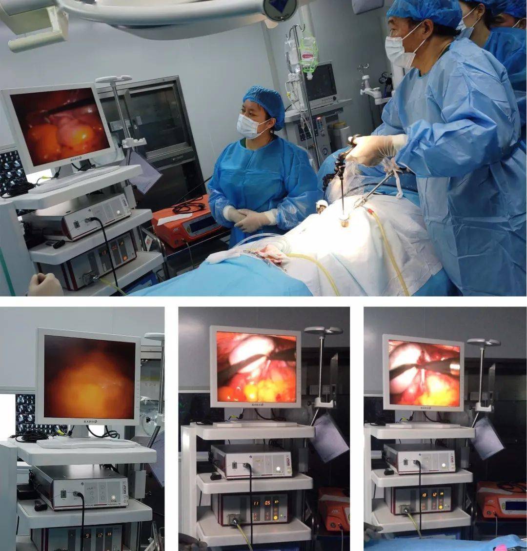 【同安精品外科—卵巢畸胎瘤剔除术】李晓奇主任治疗卵巢畸胎瘤_手术