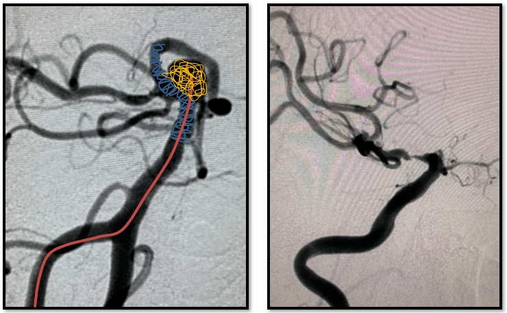弹簧圈target,sl-10微导管,echelon-10微导管,synchro2微导丝2米基底