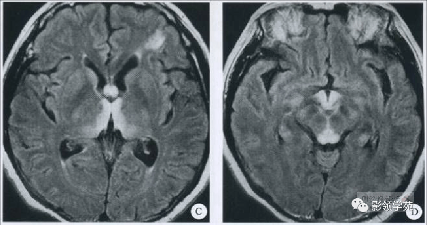 wernicke脑病mri表现