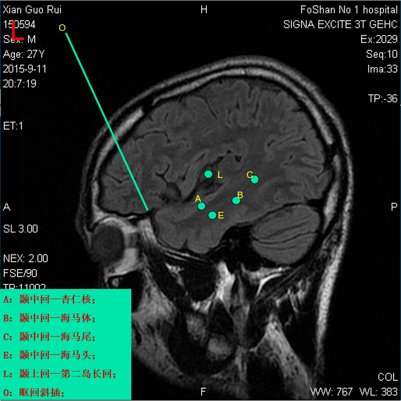 b(右侧):颞中回——海马体;a(右侧):颞中回——杏仁核;o(左侧):眶回