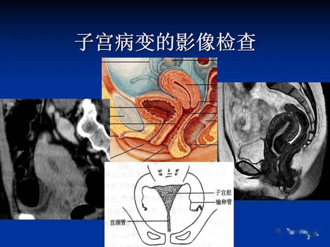 子宫肉瘤(uterine sarcomas)mr:明确肿瘤范围(一)子宫平滑肌肉瘤