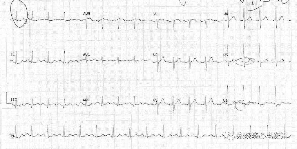 心肌缺血的心電圖表現