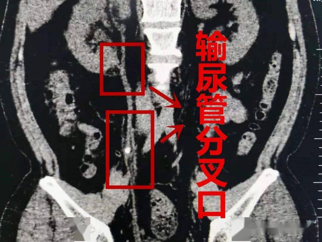 輸尿管分叉裝石頭清河大哥疼得直冒汗