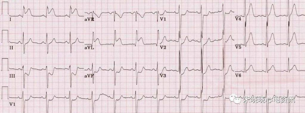 心肌缺血的心电图表现