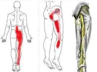 坐骨神经痛快速止痛法图片