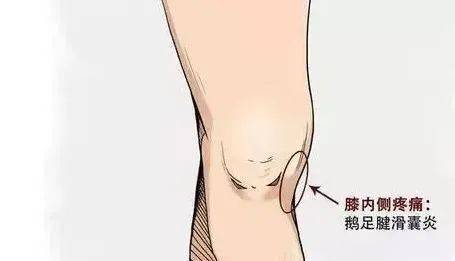 膝关节疼痛之源【收藏版】
