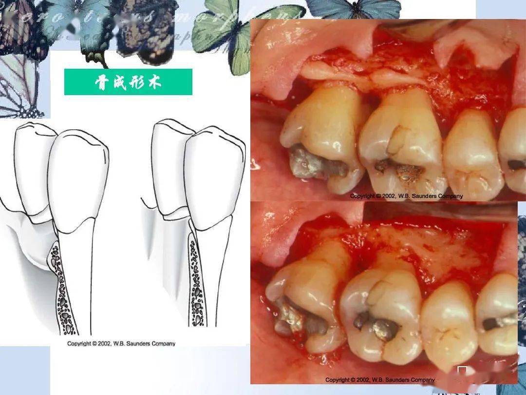 牙槽骨的吸收程度和类型