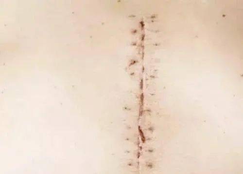 宫颈癌手术刀疤图片图片