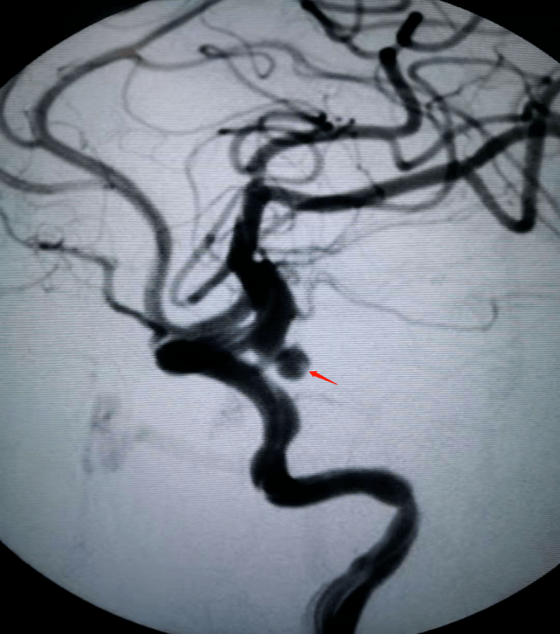急诊行脑血管造影术 动脉瘤栓塞术治疗头颅mra:左侧颈内动脉c7段动脉