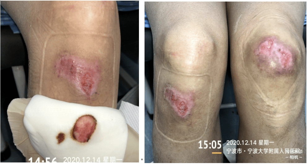 右下肢继续按上一次换药方法进行,左下肢膝盖伤口内层敷料不再使用银