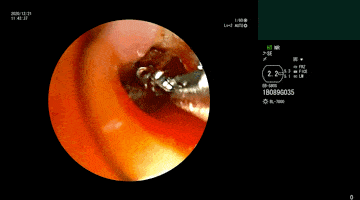 活检钳钳取异物但其中部分异物与管壁相贴,操作难度极大,稍微不慎很