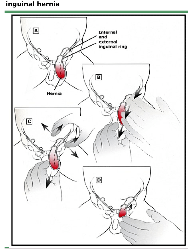 疝气掉下来推回去手法图片
