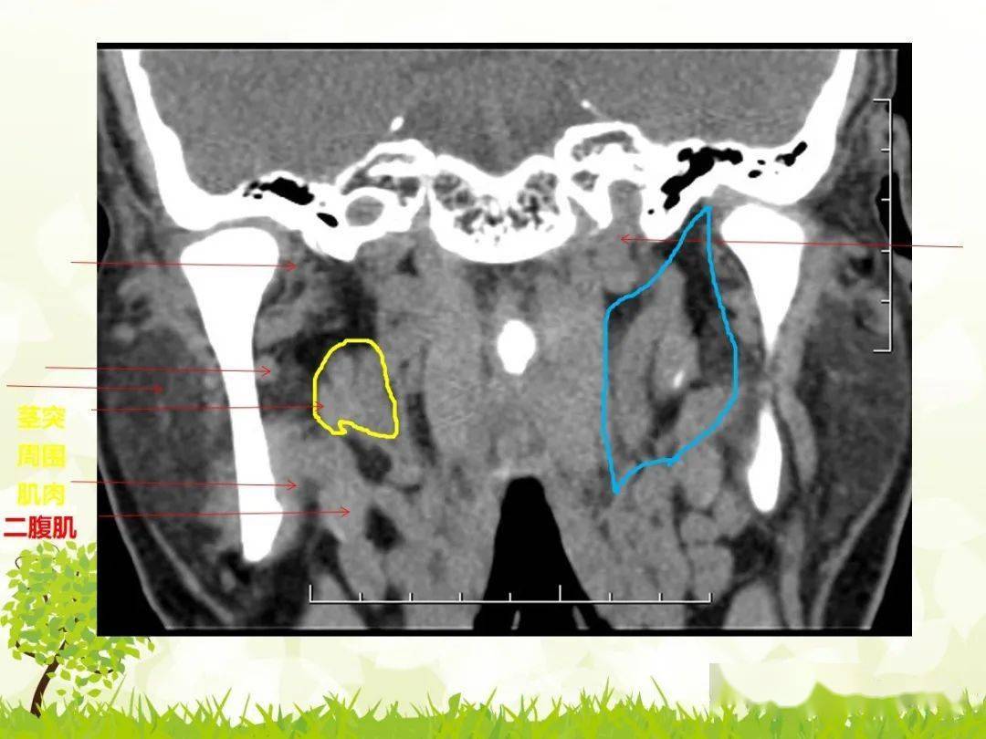 咽旁间隙解剖及常见病变影像表现