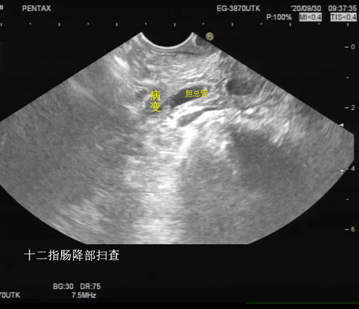 腹部b超报告单图片