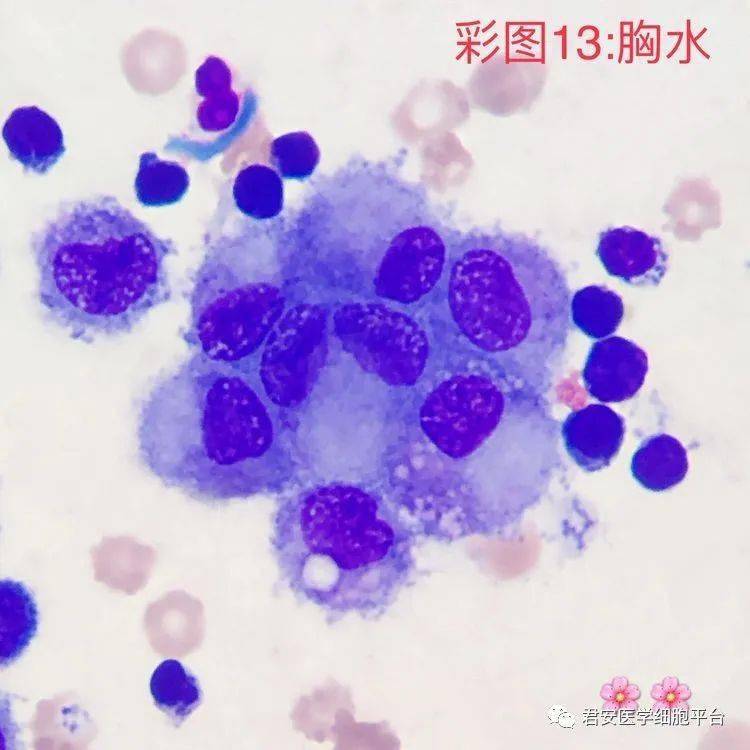 ▼「成团的间皮细胞」形态特征:图片中可见7个间皮细胞成团分布,胞体