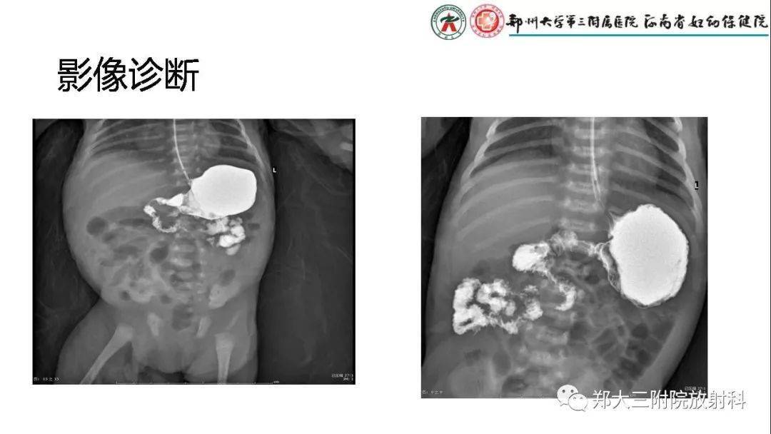 先天性肠旋转不良的影像诊断