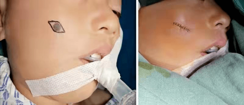 为什么面部色素痣要首选美容手术切除?