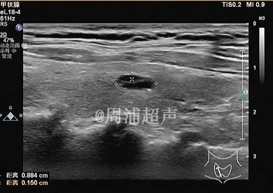 甲状腺彩超上中下极图图片