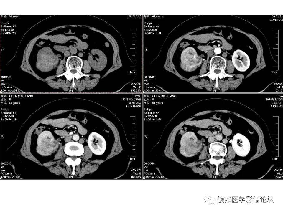 肾脏丨上皮样血管平滑肌脂肪瘤eaml