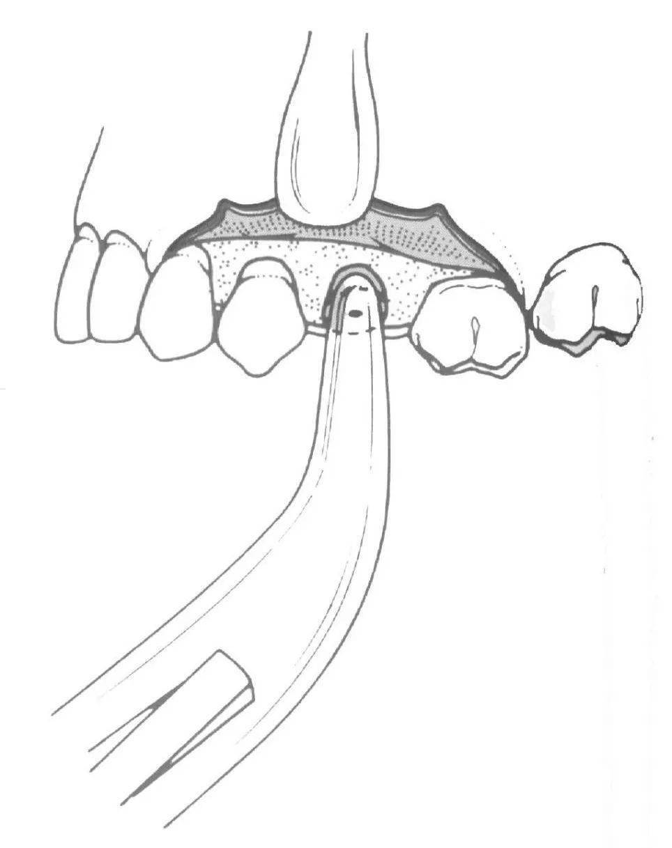 2 牙 根 挺取根法 选择合适的牙挺