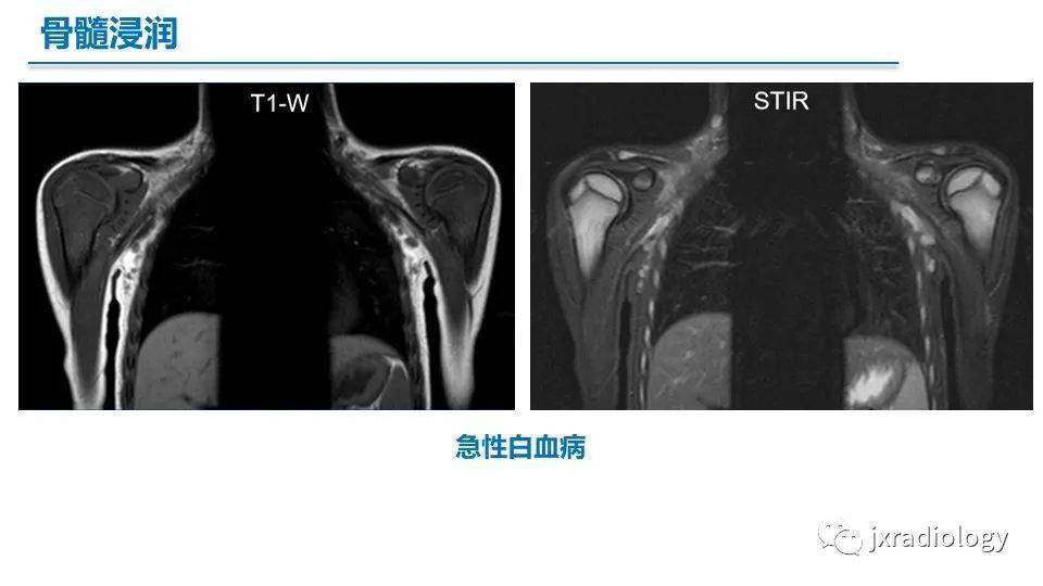 骨髓mr:红骨髓,黄骨髓和病变(mri of bone marrow:red, yellow and