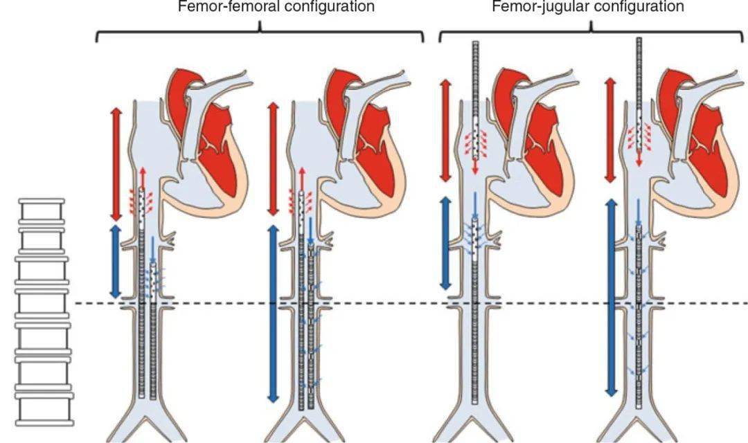 经皮置管：适应证、操作技术和并发症 |《ECMO——成人的体外生命支持》文章精选_导管