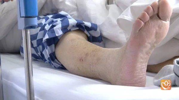 老人右腿突然发冷差点截肢冬天这种病很容易找上门